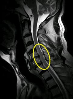 頸椎MRI 頸椎ヘルニア