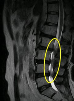 腰椎MRI腰部脊柱管狭窄症